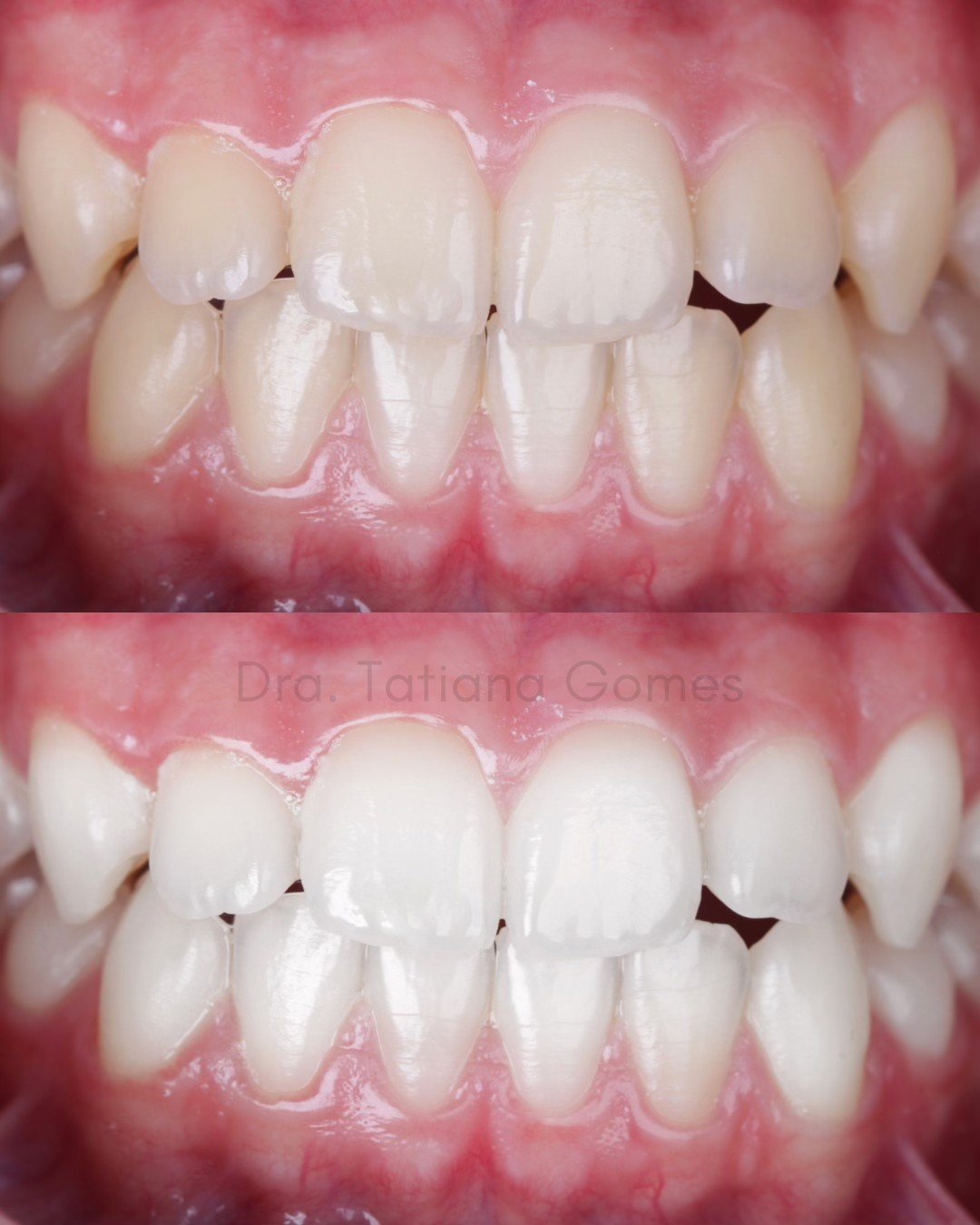 Clareamento dental