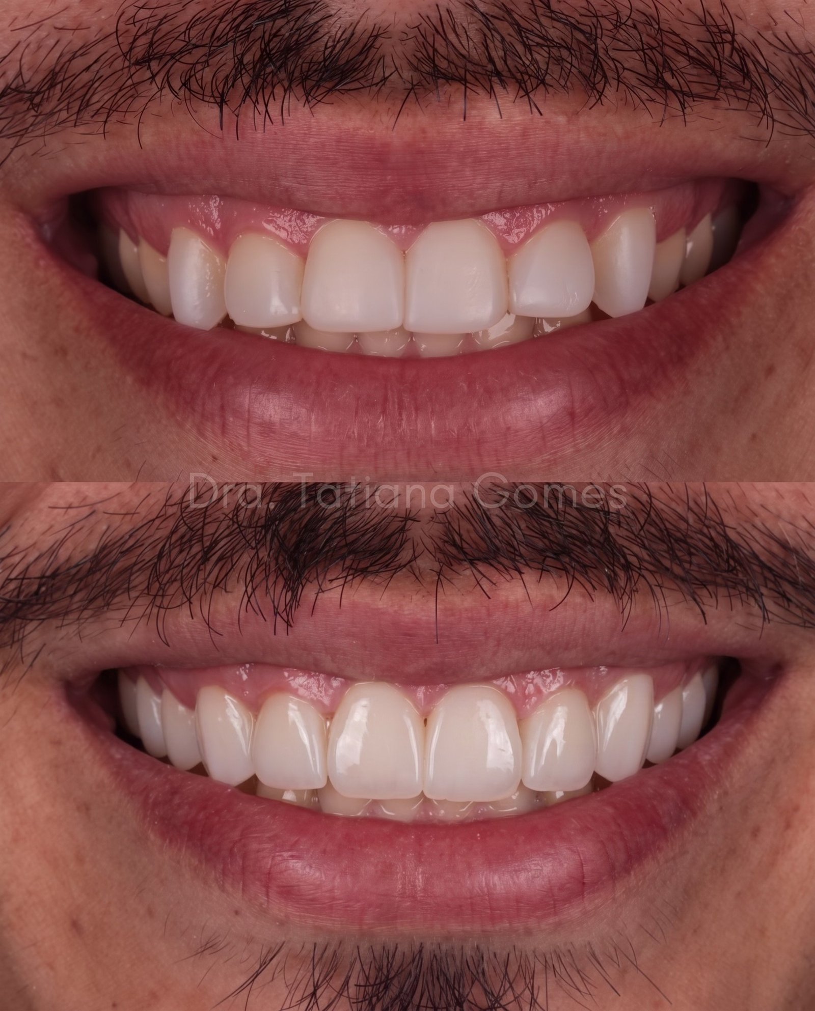 Retrabalho em resina composta